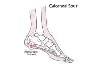 Can Relief Be Found From Heel Spurs?