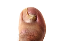 Possible Causes of Toenail Loss