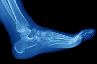 Foot Pain and Metatarsalgia